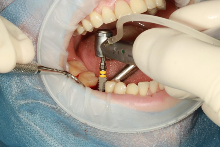 Dental implant procedure with precision tools, sterile gloves, and clean environment.