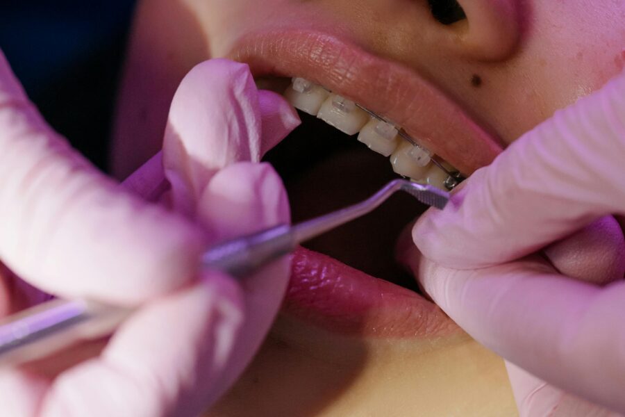 Dental procedure with braces, showcasing orthodontic care, gloves, and instruments in a clean clinic.